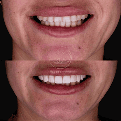 Smile Design and dental veneers improve tooth shape, color and harmony to achieve a natural smile